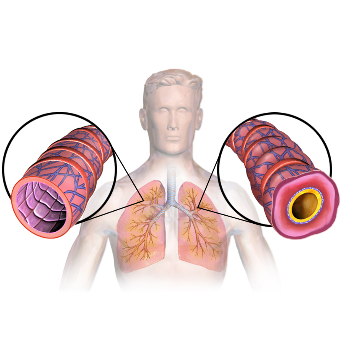 Therapy of asthma